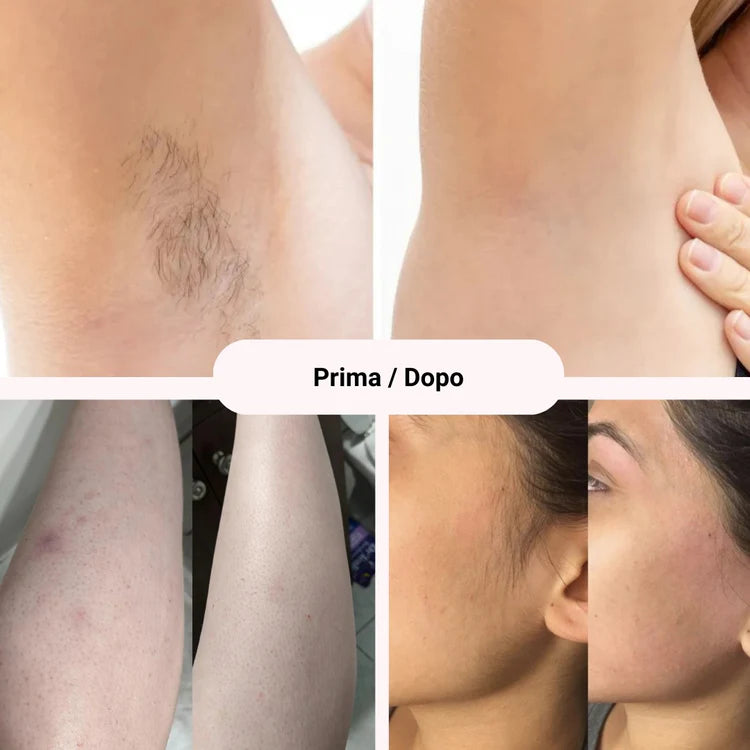 Removely IPL 3+ (Try & Buy Italy)